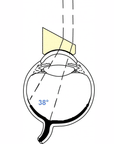 Landers High Reflective index Lens - 30° Prism Lens