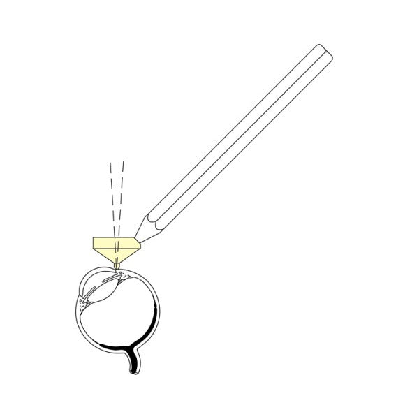 Ocular Instruments Layden Suture Lysis Laser Lens