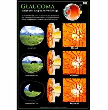 Patient Education Poster - Glaucoma