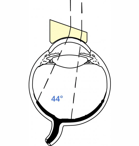 Landers High Reflective Index Lens 20° Prism Lens Optego Singapore